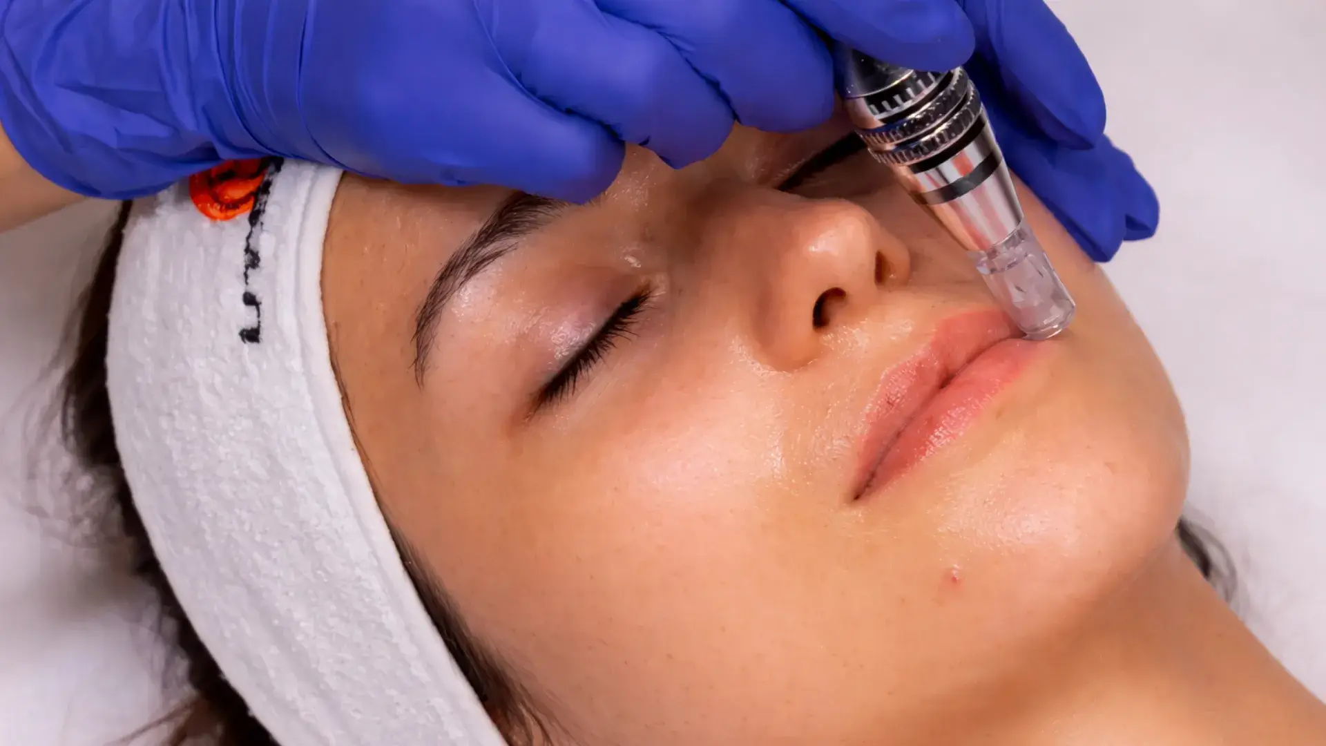 Tratamiento Hyalu-in para hidratación facial profunda en Albacete