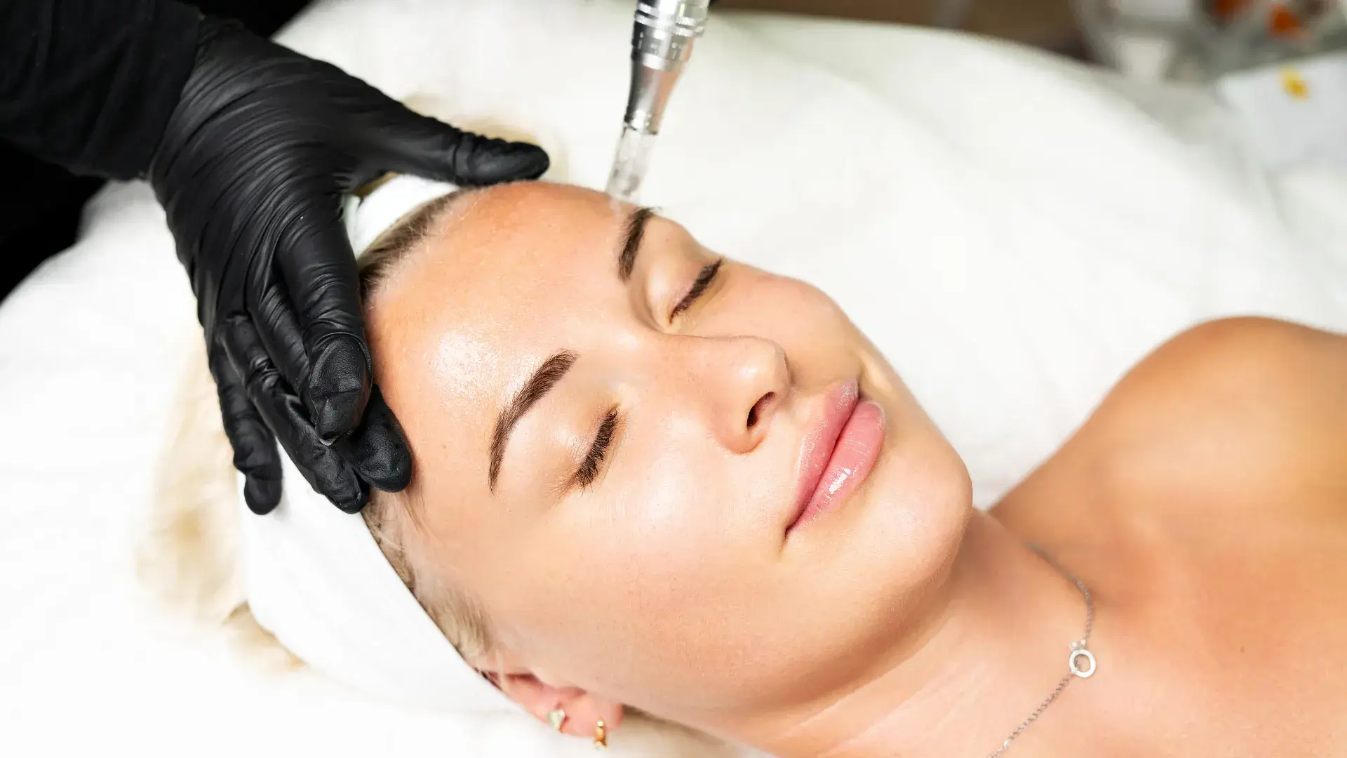 Tratamiento de microneedling facial profesional en Albacete
