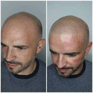 Resultado de micropigmentación capilar en centro de estética Albacete
