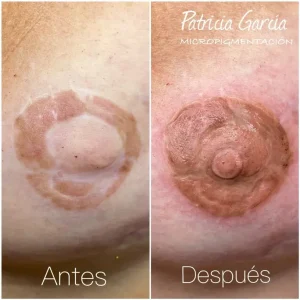 Resultado de micropigmentación de areolas en Lucía Argandoña Albacete