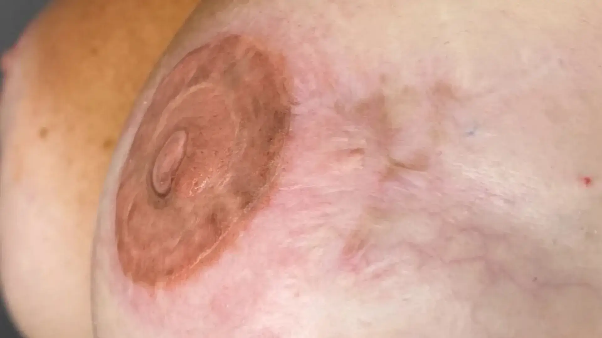 Micropigmentación de areolas en centro de estética Albacete