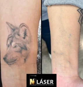 Eliminación de tatuajes con láser profesional en Albacete