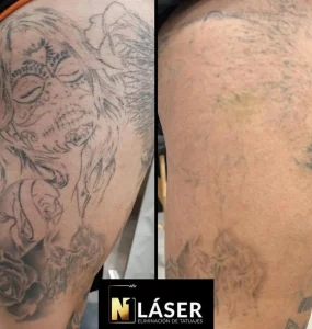 Sesión de láser para eliminación de tatuajes en Lucía Argandoña Albacete