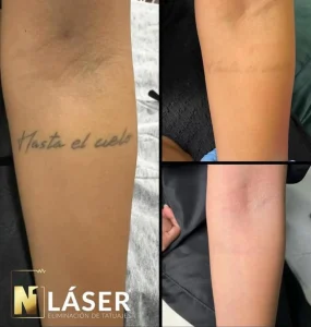 Resultado de borrar tatuaje con láser profesional en Albacete