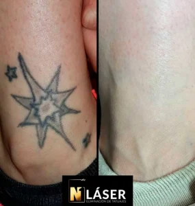 Resultado de eliminación de tatuaje con láser en centro de estética Albacete